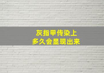 灰指甲传染上多久会显现出来