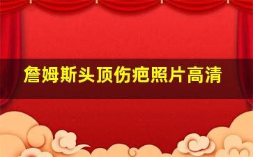 詹姆斯头顶伤疤照片高清